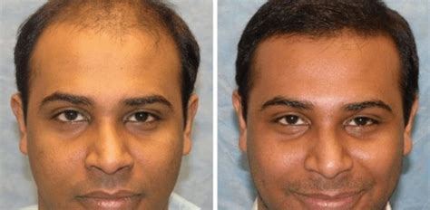 best hair transplant surgeon turkey.